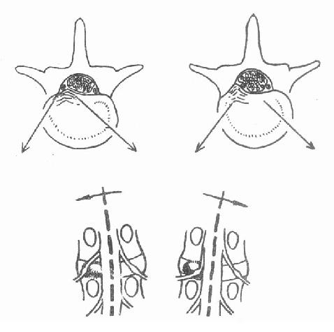 脊柱側彎的方向，髓核突出部位與神經根的關係