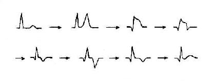 急性心肌梗死心电图演变规律示意图