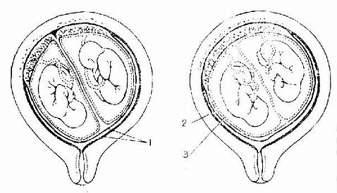 雙胎胎盤與胎膜