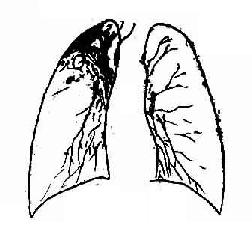右上慢性纖維空洞型肺結核