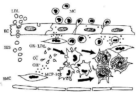 單核細胞遷入內膜及泡沫細胞形成模式圖