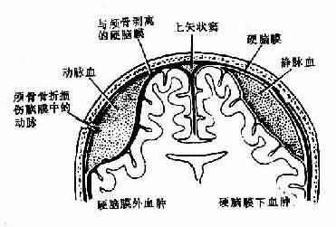 硬腦膜外血腫與硬腦膜下血腫示意圖