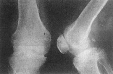 關節退行性變－膝關節退行性骨關節病