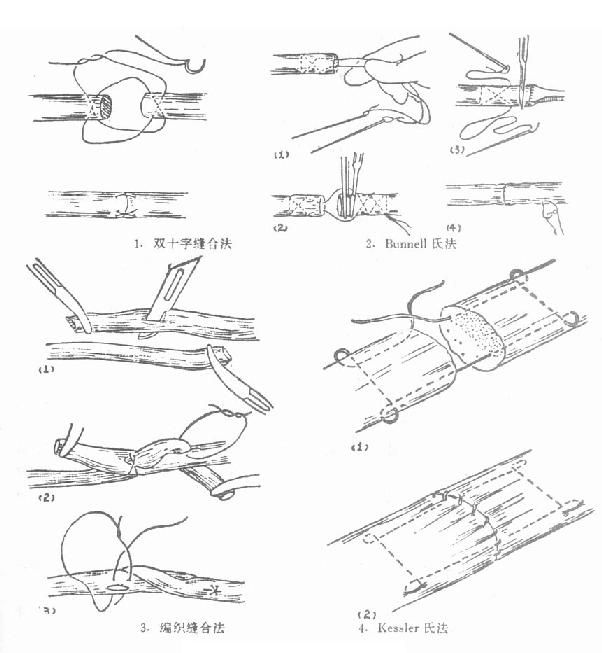 肌腱的各種縫合法