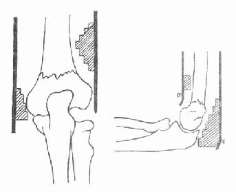 肱骨髁上骨折固定法