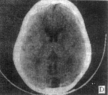 正常頭部CT掃描
