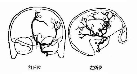 左額葉腦膜瘤
