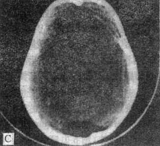 正常頭部CT掃描