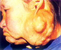 腮腺混合瘤(左腮部)