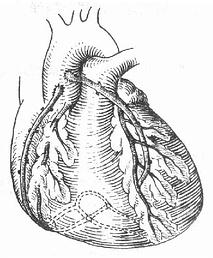 升主動脈-冠狀動脈旁路移植術