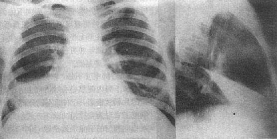 右肺中叶肺不张（正、侧位）