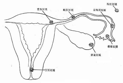 宮外妊娠的部位