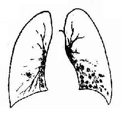 支氣管肺炎