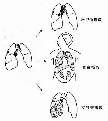 肺原發性結核病播散途徑示意圖