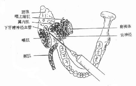 下牙槽神經阻滯麻醉部位的解剖關係