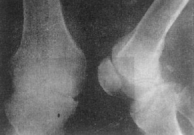 關節破壞——膝關節結核
