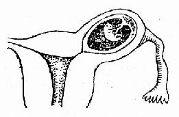 輸卵管間質部妊娠