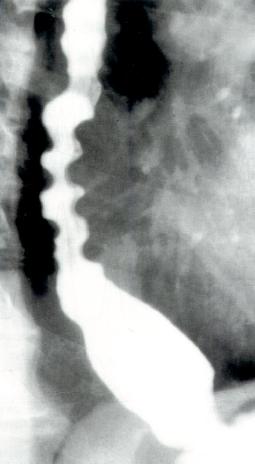 DES病人X線吞鋇檢查顯示開塞鑽食管