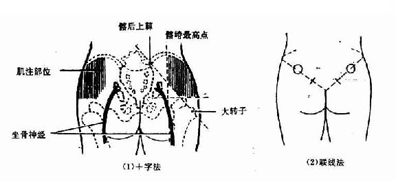 臀大肌肌內(nèi)注射定位法