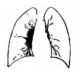 支氣管淋巴結結核腫瘤型