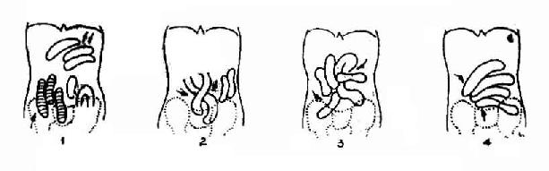 小腸扭轉的平片表現（臥位）