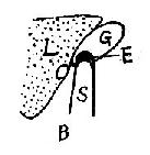 胆囊结石典型声象图