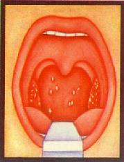 扁桃體及咽部角化症