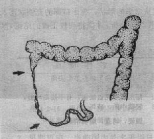 腸結核（潰瘍型）