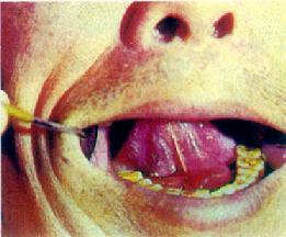舌下囊腫(左)