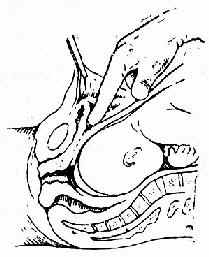 分離膀胱的矢狀剖面圖