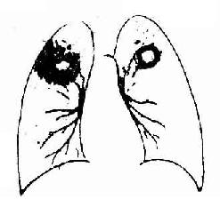 两肺上部浸润型肺结核