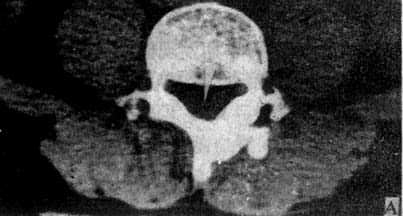 正常脊柱CT横断面扫描