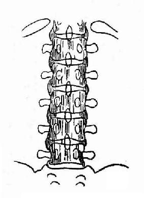強直性脊柱炎示「竹節狀」脊柱