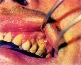 齦癌(左上牙齦)