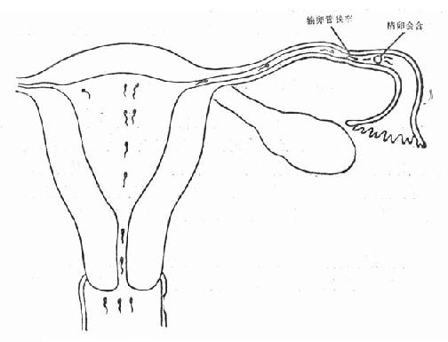 輸卵管狹窄形成卵管妊娠