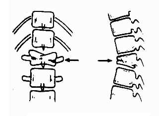 腰椎椎体压缩性骨折示意图