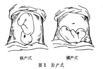 胎產式胎位