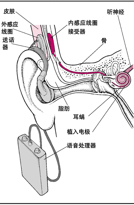 耳蝸植入