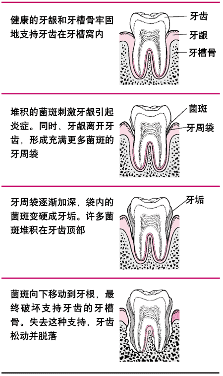 從菌斑到牙齒損失的過程