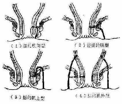 肛瘘的四种解剖类型