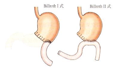 胃部分切除術的常見類型