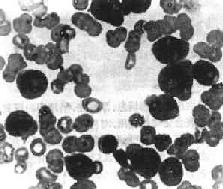 急性粒細胞性白血病