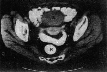 女性盆腔正常CT表现
