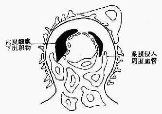 膜性增生性腎小球腎炎Ⅰ型示意圖