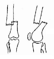 股骨下1／3横行骨折，远段向上后内移位，骨折两断端重迭