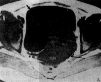 子宮肌瘤MRI