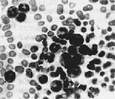 慢性粒細胞性白血病