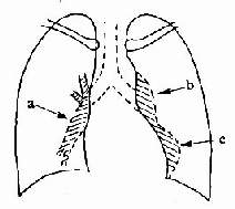 慢性肺原性心病X線胸片正位