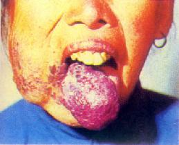 海绵状血管瘤(舌及左颊部)