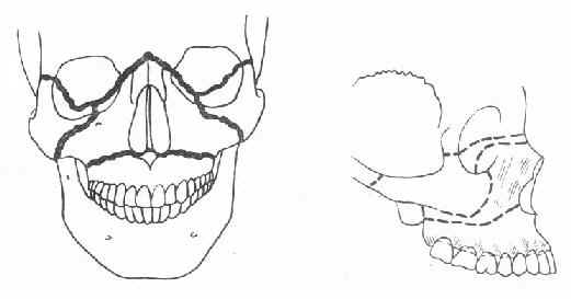 上頜骨骨折三種類型